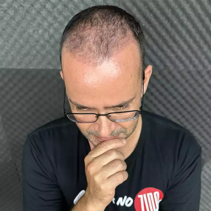 Transplante Capilar na Clínica Cappelli - 1 mes e 20 dias pós transplante